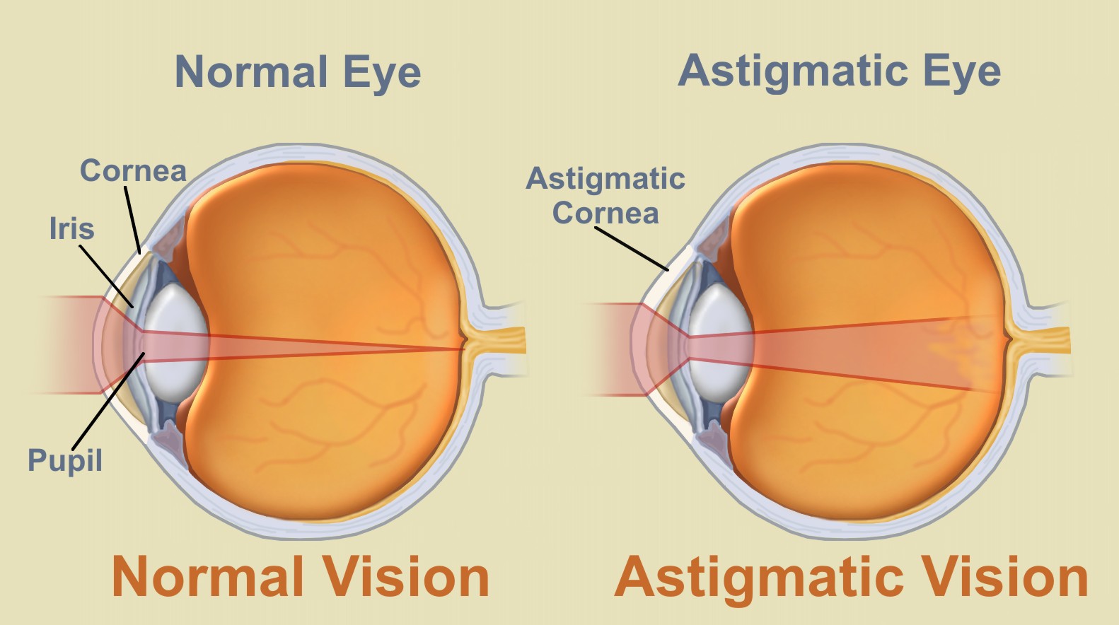 Astigmatism In My Eye